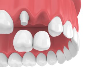 What Is the Difference Between a Bridge and an Implant?