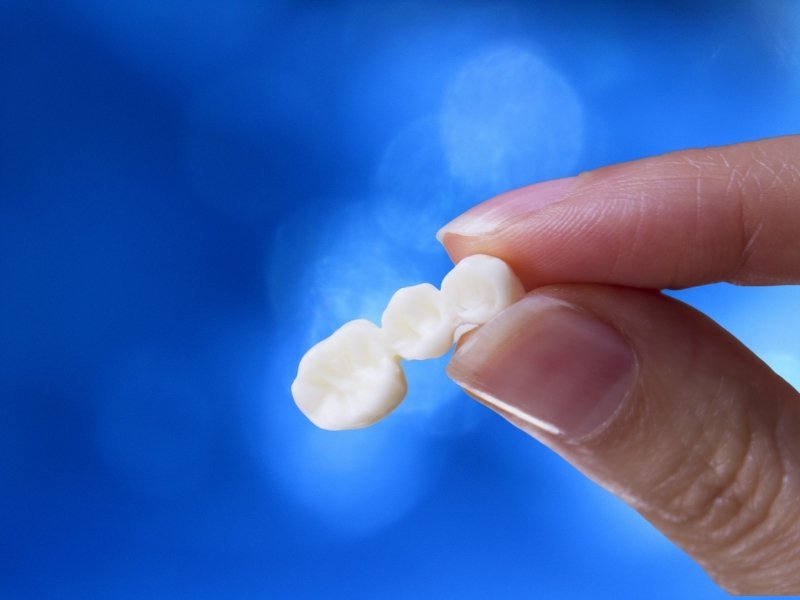 Benefits & Cost: What Is the Difference Between a Bridge and a Dental Implant?