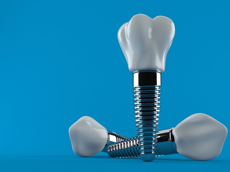 How to Care for Your Dental Implant
