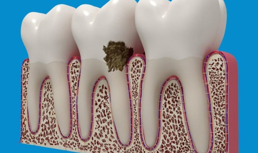 Controlling Periodontal Disease | What You Need to Know cover