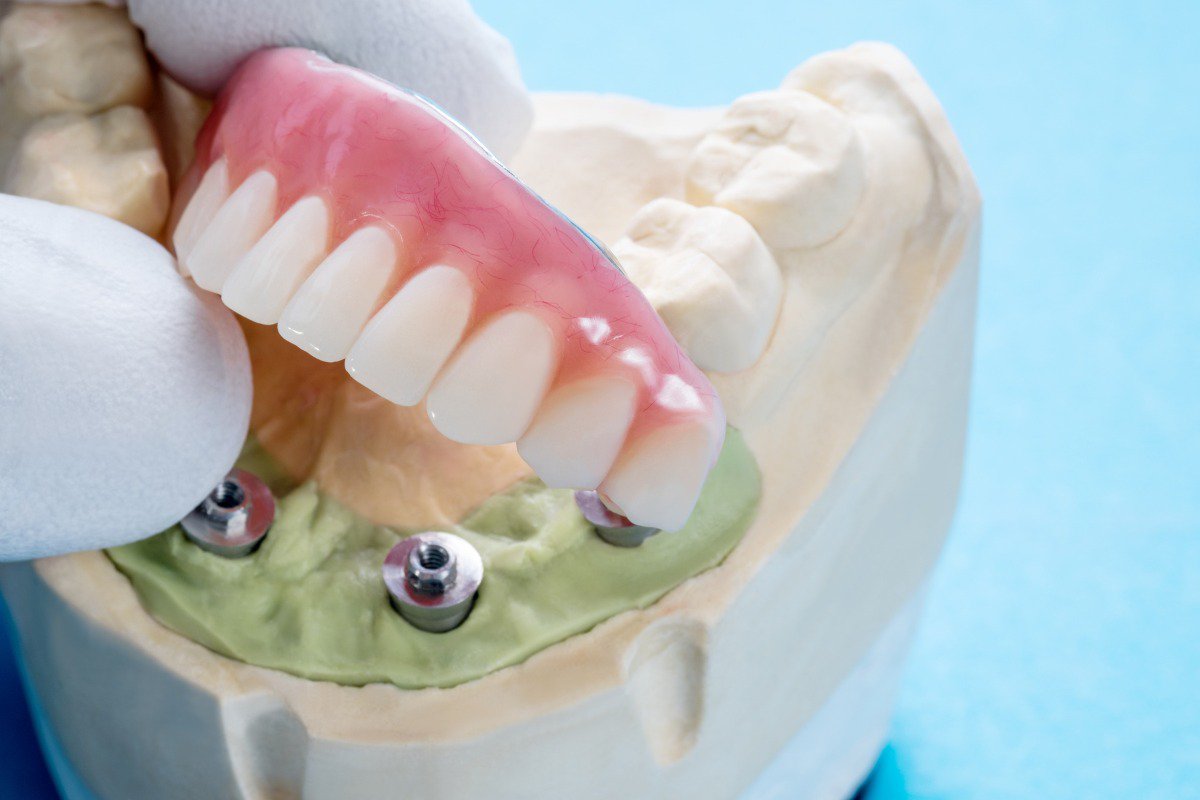 Dental Implants: Are They Right For You? cover