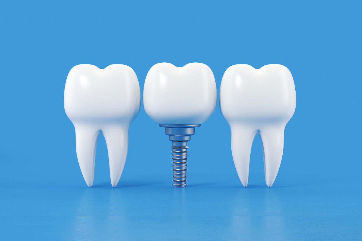The Benefits of Dental Implants cover