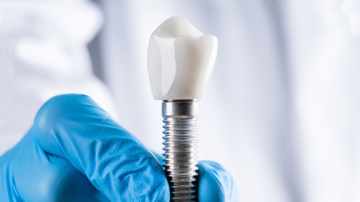 Close-up of gloved fingers holding a dental implant, showcasing its sleek metal design and precision