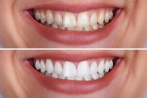 How to Whiten Your Sensitive Teeth Safely cover