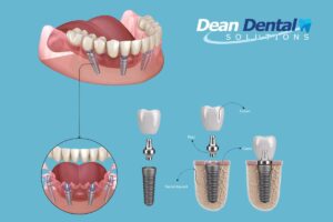 All-on-4 dental implants in North Little Rock