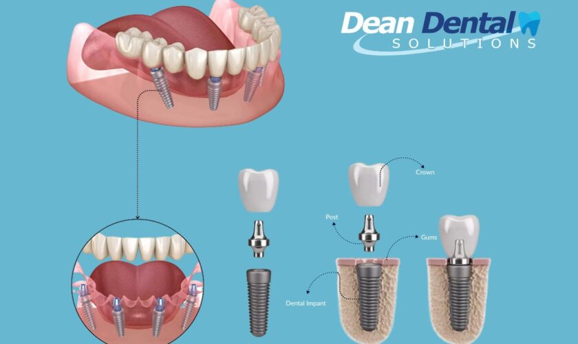 All-on-4 dental implants in North Little Rock