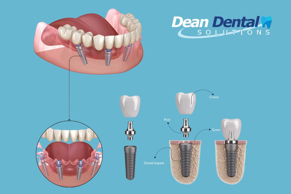 All-on-4 dental implants in North Little Rock