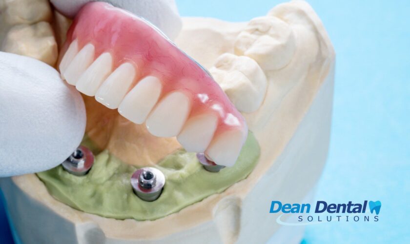 Permanent Dentures vs Removable: Which Should You Choose? cover
